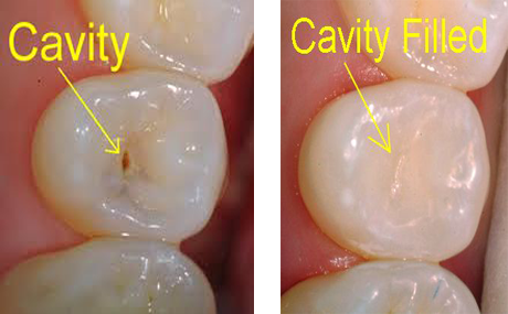 How To Fix Class I Cavity? Fillings Explained