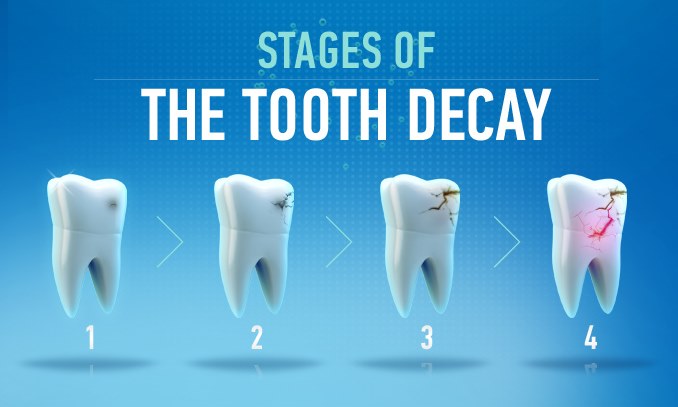 How To Fix Front Tooth Cavity? Easy Solutions How To Fix Front Tooth Cavity? Easy Solutions