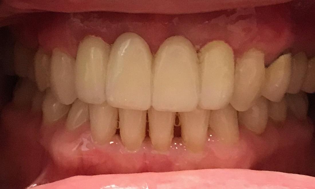 How To Get Bridge On Front Teeth? Cosmetic Solution