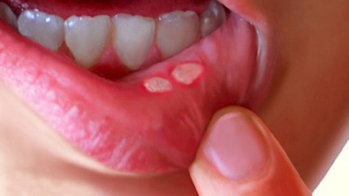 How To Heal Celiacrelated Mouth Sores? Expert Tips How To Heal Celiacrelated Mouth Sores? Expert Tips