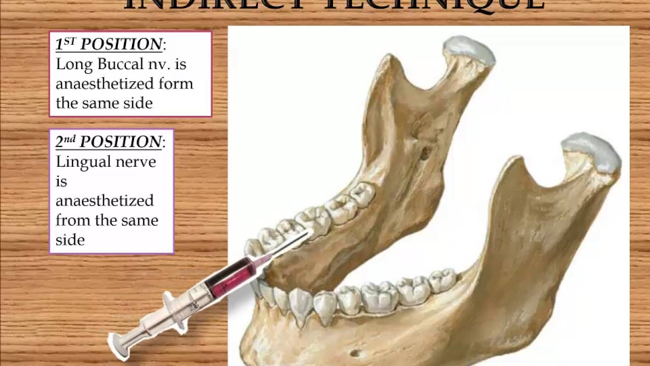 How To Perform Alveolar Nerve Block? Stepbystep