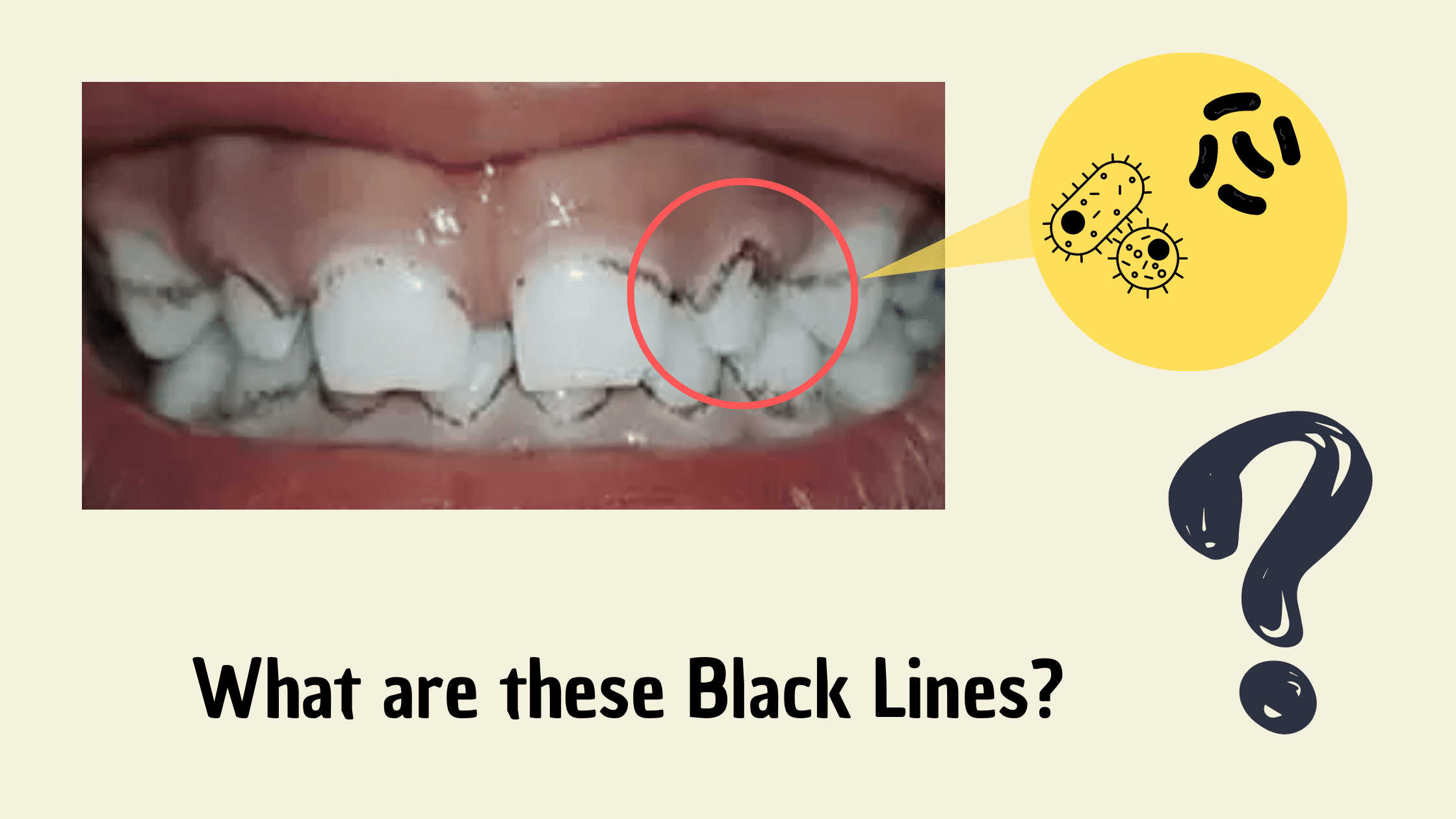 How To Remove Black Line On Tooth? Easy Solution