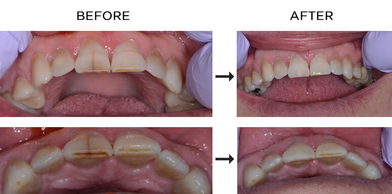 How To Remove Craze Lines? Get Perfect Smile How To Remove Craze Lines? Get Perfect Smile