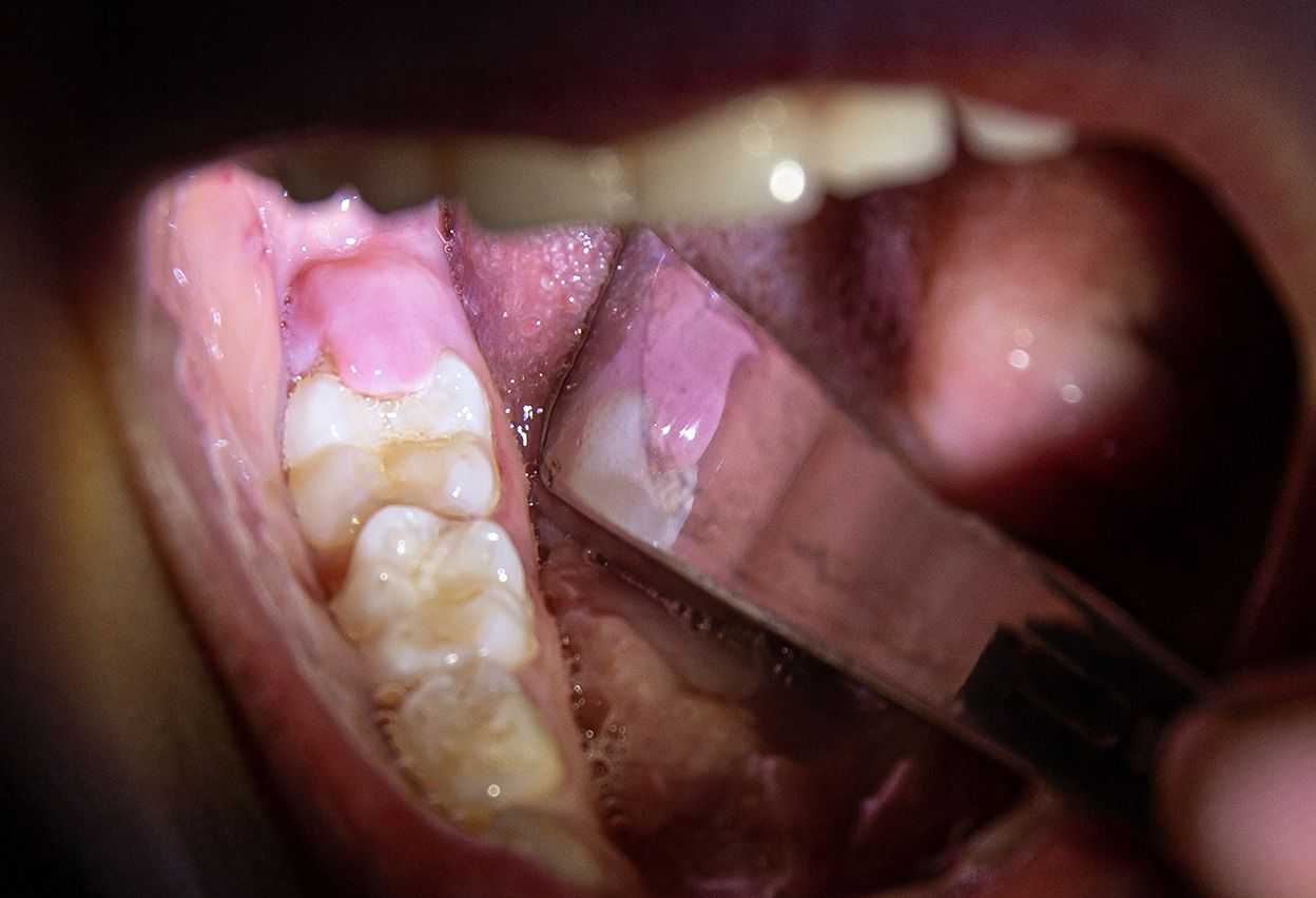 How To Remove Gum Grown Over Tooth? Solutions