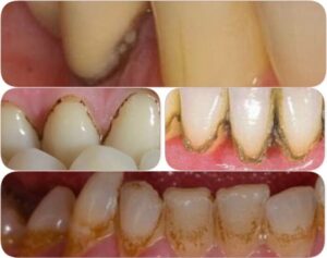 How To Remove White Stuff From Teeth Near Gums?
