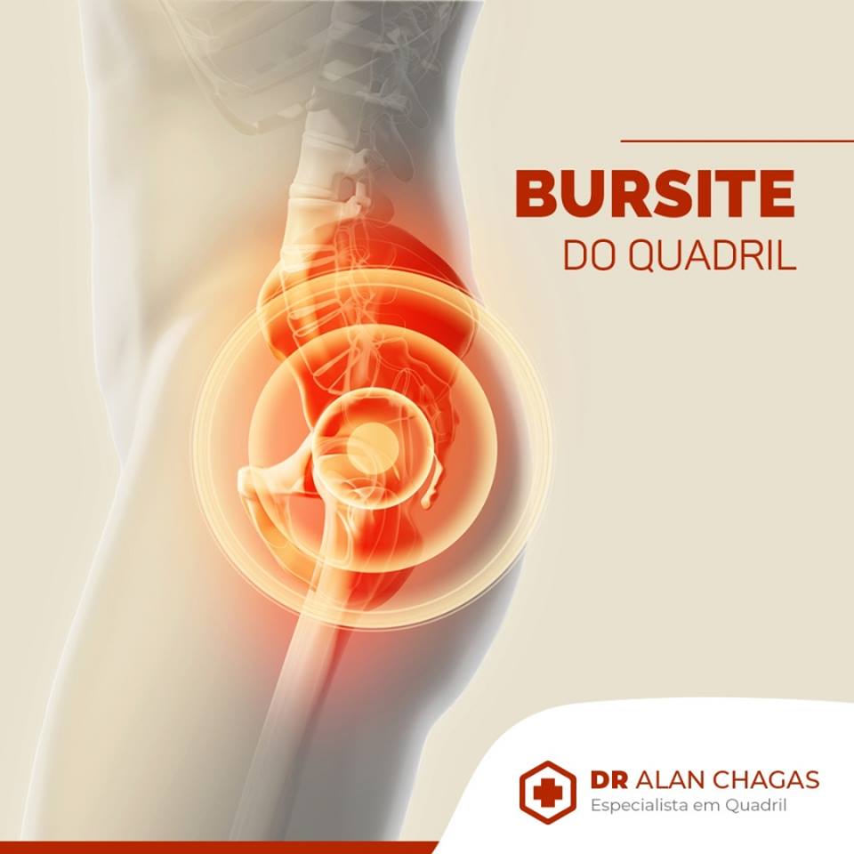 How To Treat Bursite No Quadril? Effective Solutions