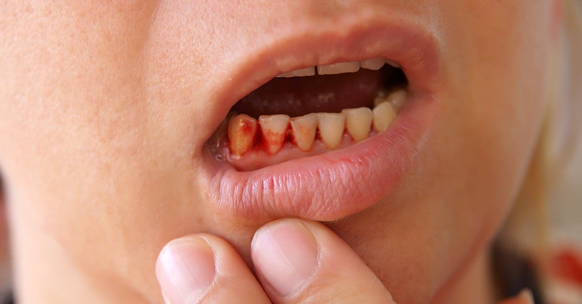 How To Treat Cut On Gums Above Tooth? Home Remedies