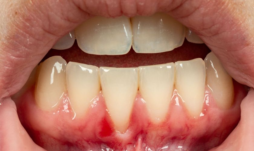 How To Treat Dark Spot On Gums? Easy Cure