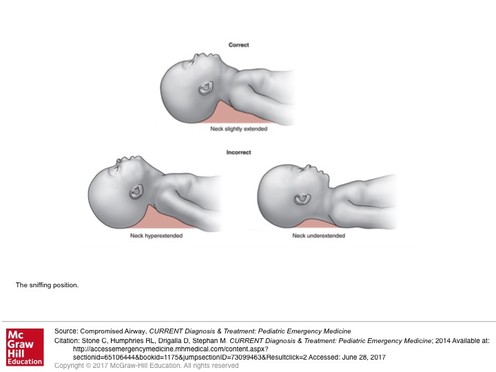 How To Use Sniffing Position Emt? Emergency Tips