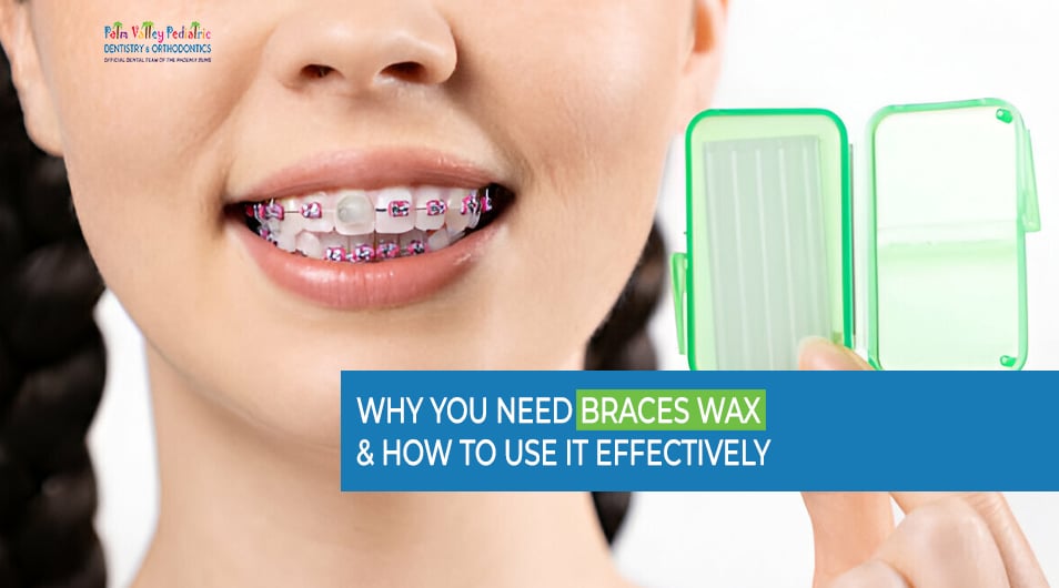 How To Use Wax On Braces? Easy Comfort Tips How To Use Wax On Braces? Easy Comfort Tips