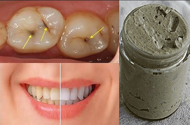 How To Whiten Teeth And Gum? Easy Solution