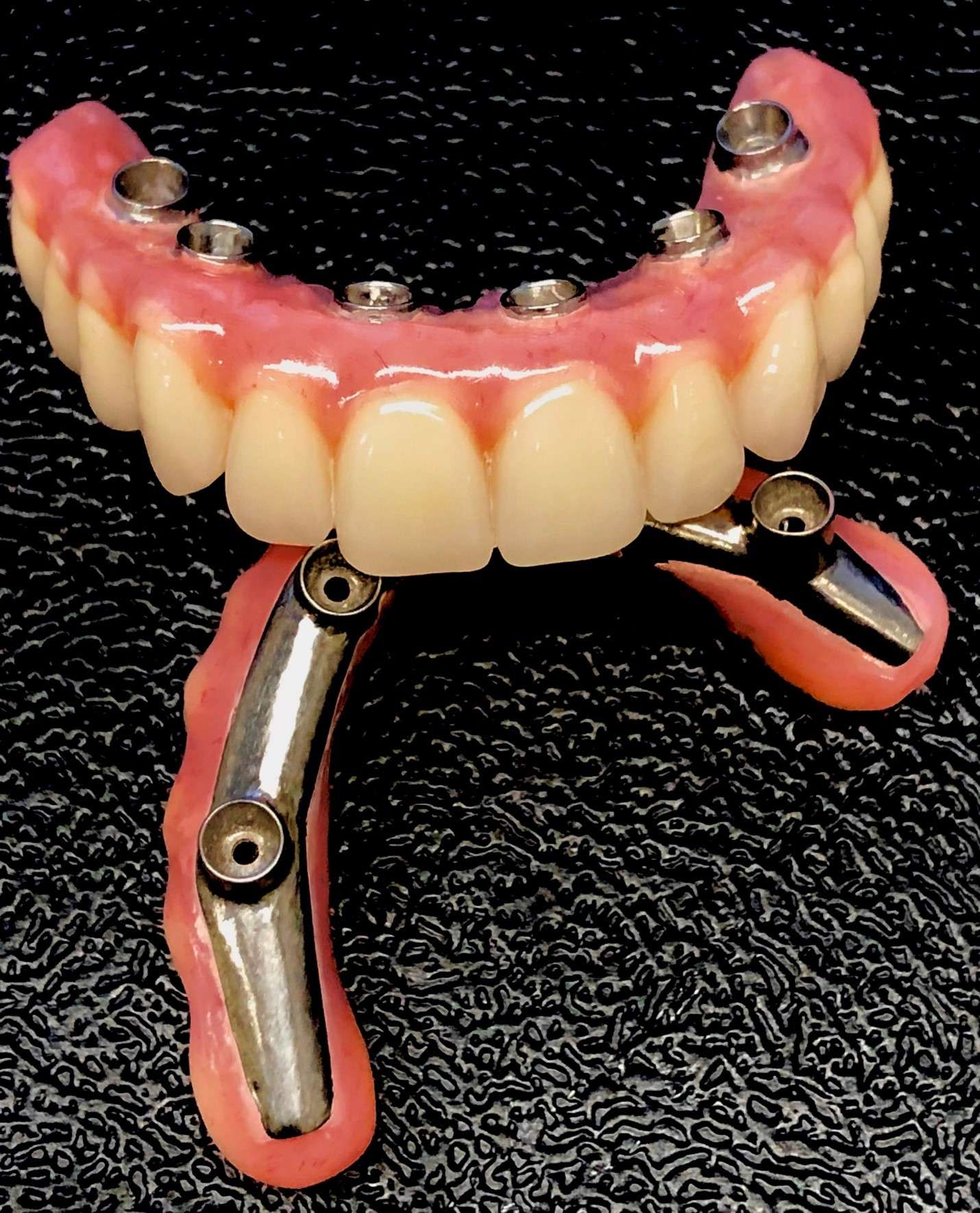 Implant Supported Prosthesis