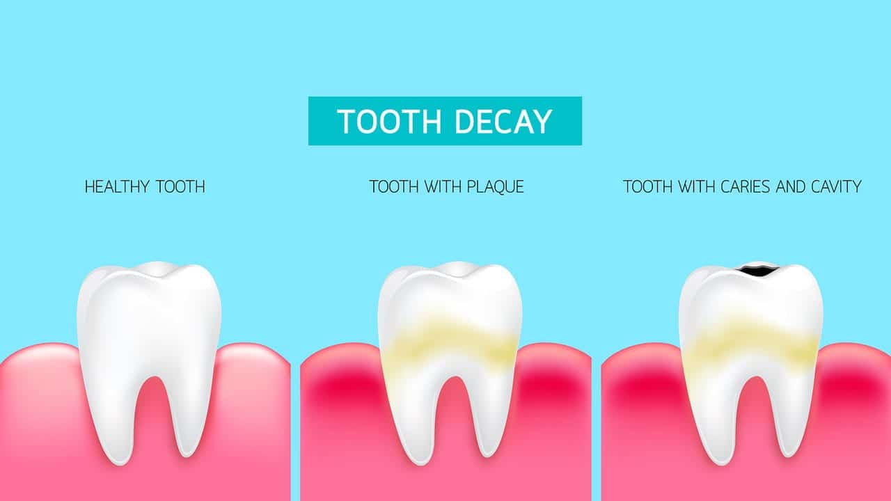 Infant Gum Care: Prevent Tooth Decay Early