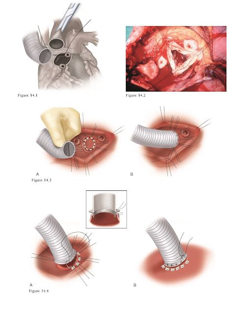 Is The Bentall Procedure The Right Choice In Bicuspid Aortic Valve Is The Bentall Procedure The Right Choice In Bicuspid Aortic Valve