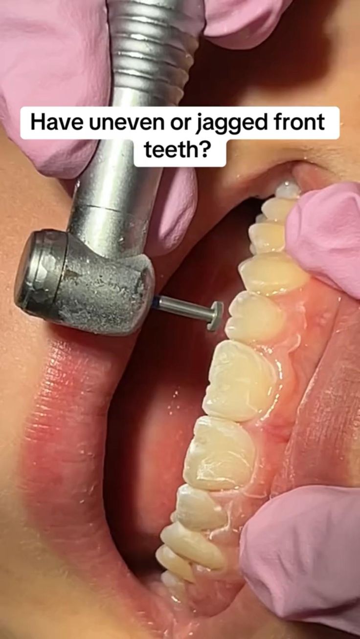 Jagged Teeth Fix: Regain Confidence Quickly