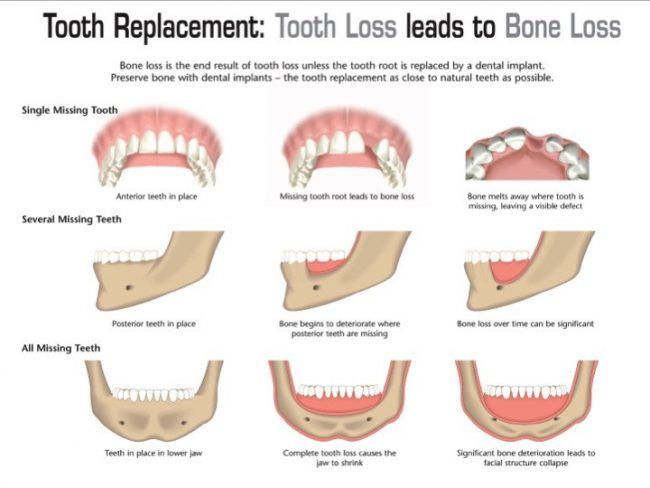 Jaw Bone Resorption: Stop Bone Loss Now