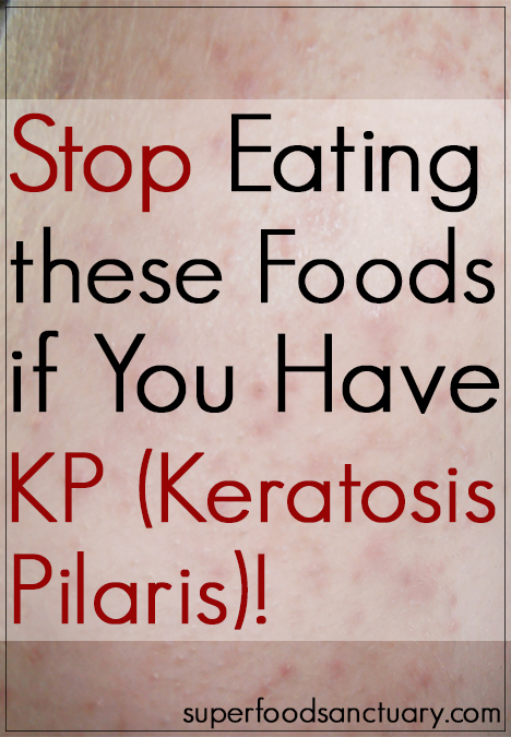 Keratosis Pilaris Foods To Avoid