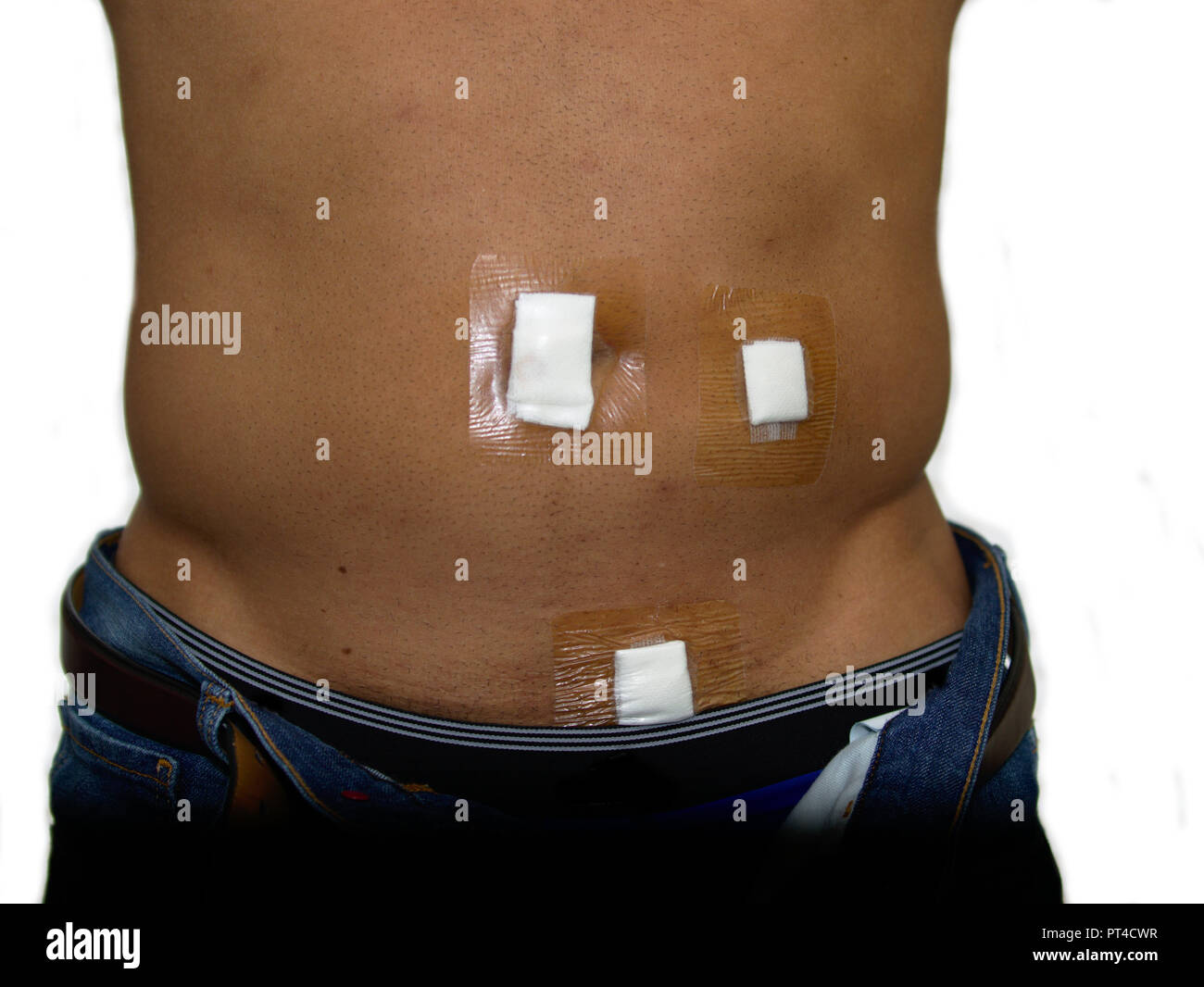 Laparoscopic Appendectomy Scars