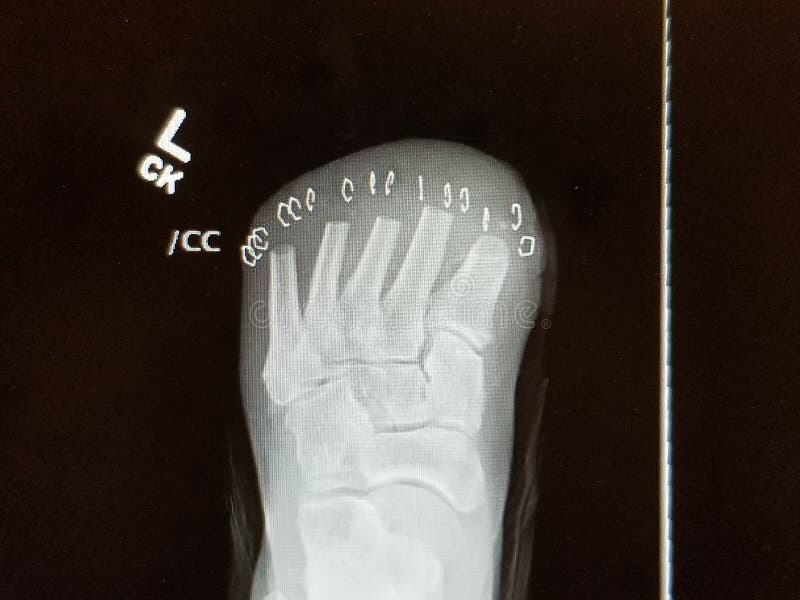 Left Foot Amputation Care: Heal Faster Left Foot Amputation Care: Heal Faster