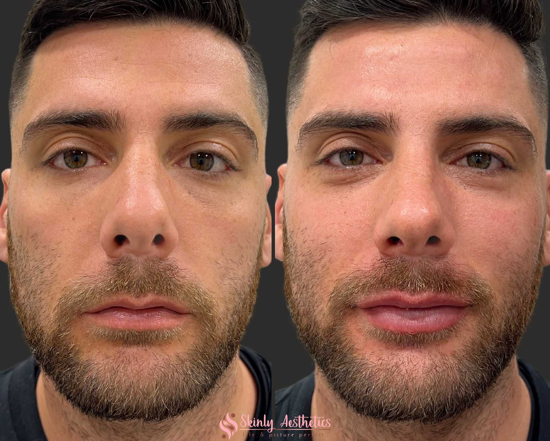 Lip Fillers Blindness Lip Fillers Blindness