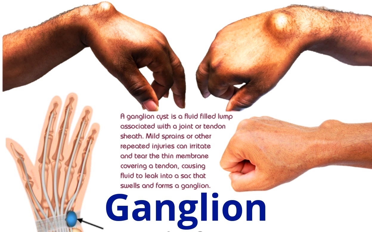 Lipoma Vs Ganglion Cyst