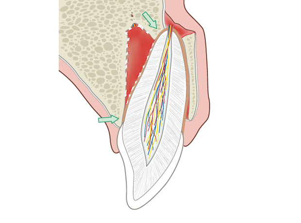Luxation Of Tooth