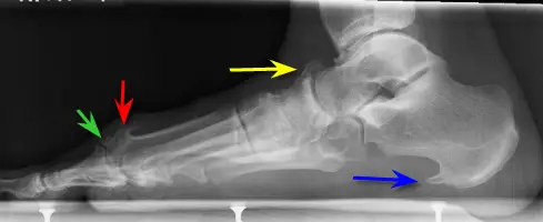 Mandible Bone Spur Symptoms Explained