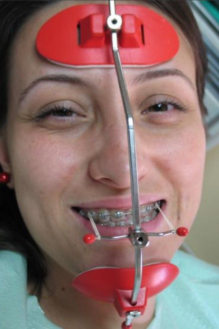 Metal Teeth Brace