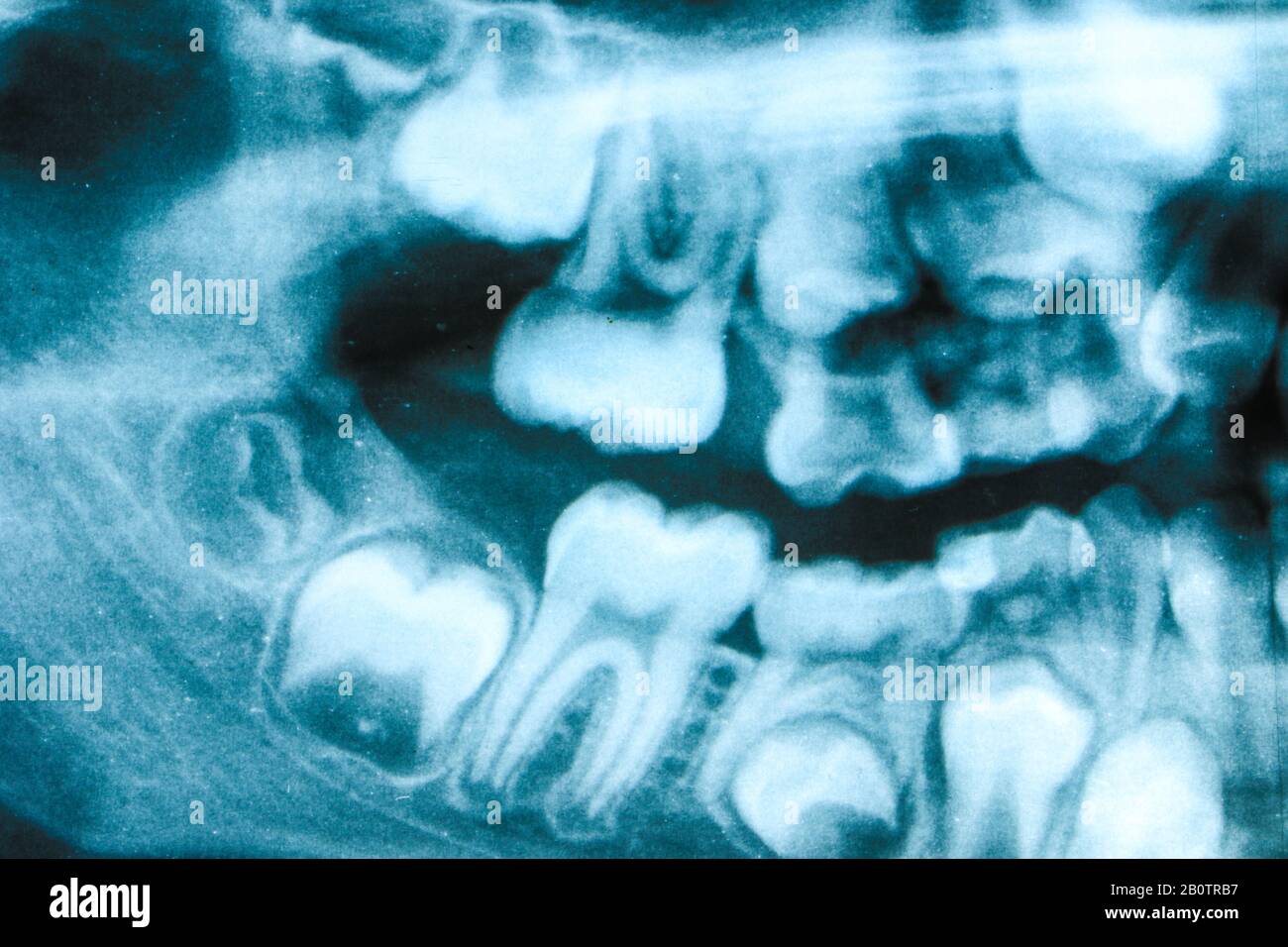 Milk Teeth Xray