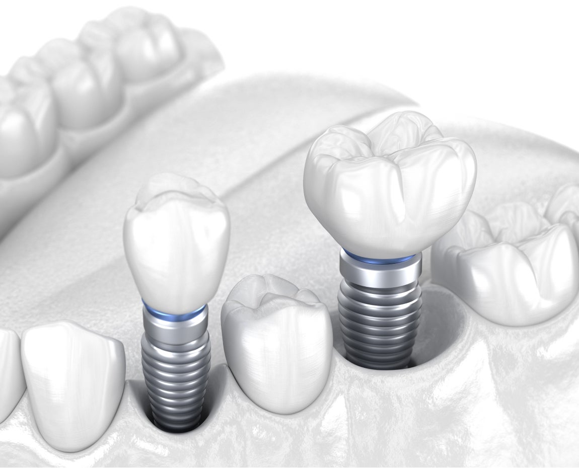 Molar Dental Implant Costs Explained Factors Pricing Aspen Dental Molar Dental Implant Costs Explained Factors Pricing Aspen Dental