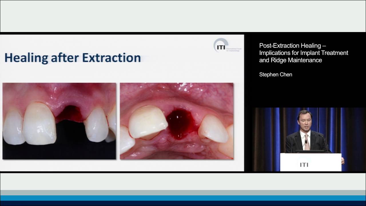 Molar Extraction Healing
