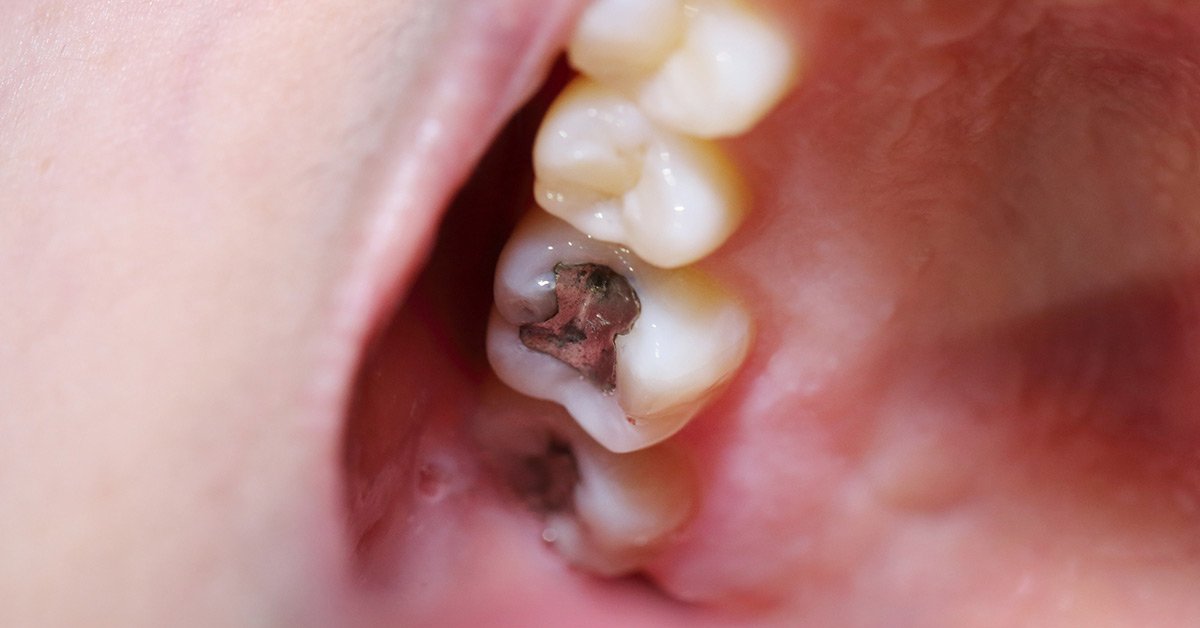 New Filling Pain