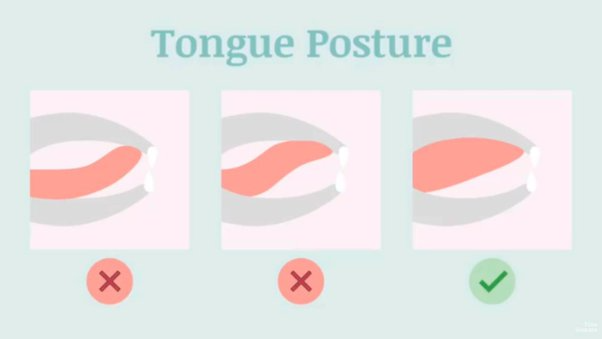 Normal Tongue Posture