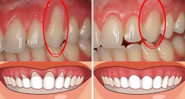 Numb Gums Front Teeth
