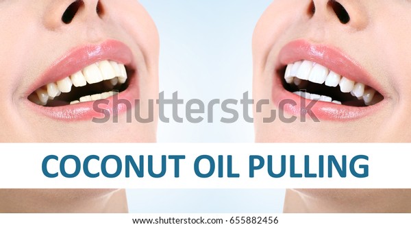 Oil Pulling And Teeth Whitening