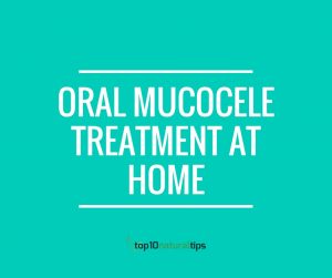 Oral Mucocele Home Treatment