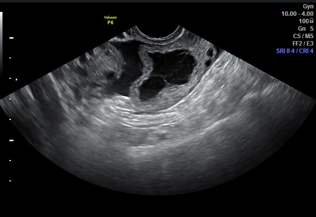 Ovarian Cyst Vs Appendicitis Symptoms Ovarian Cyst Vs Appendicitis Symptoms