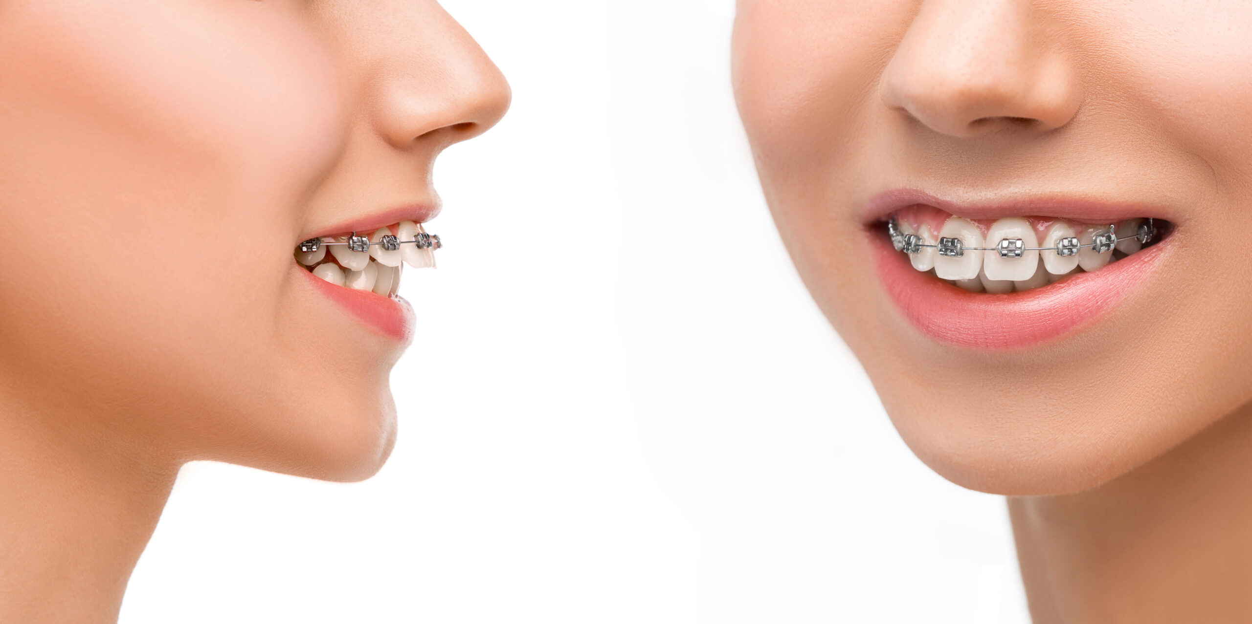 Overjet And Overbite: Understand The Distinction