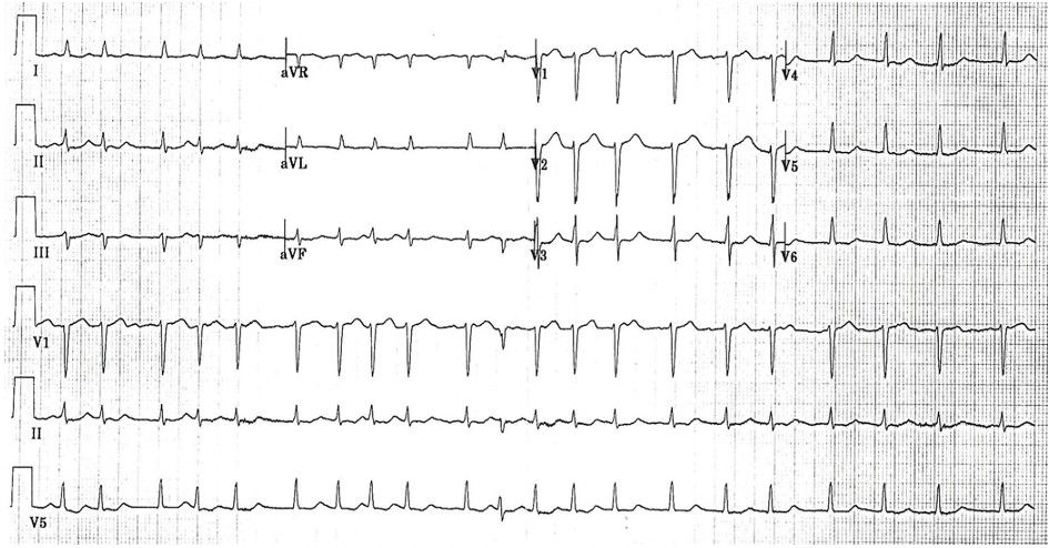 Pain After Cabg
