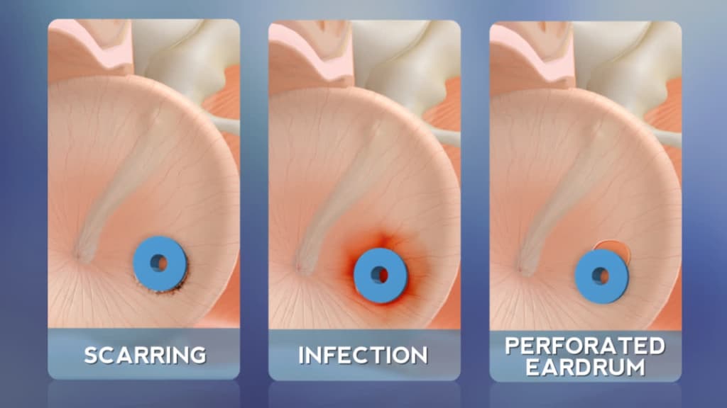 Pain After Ear Tubes