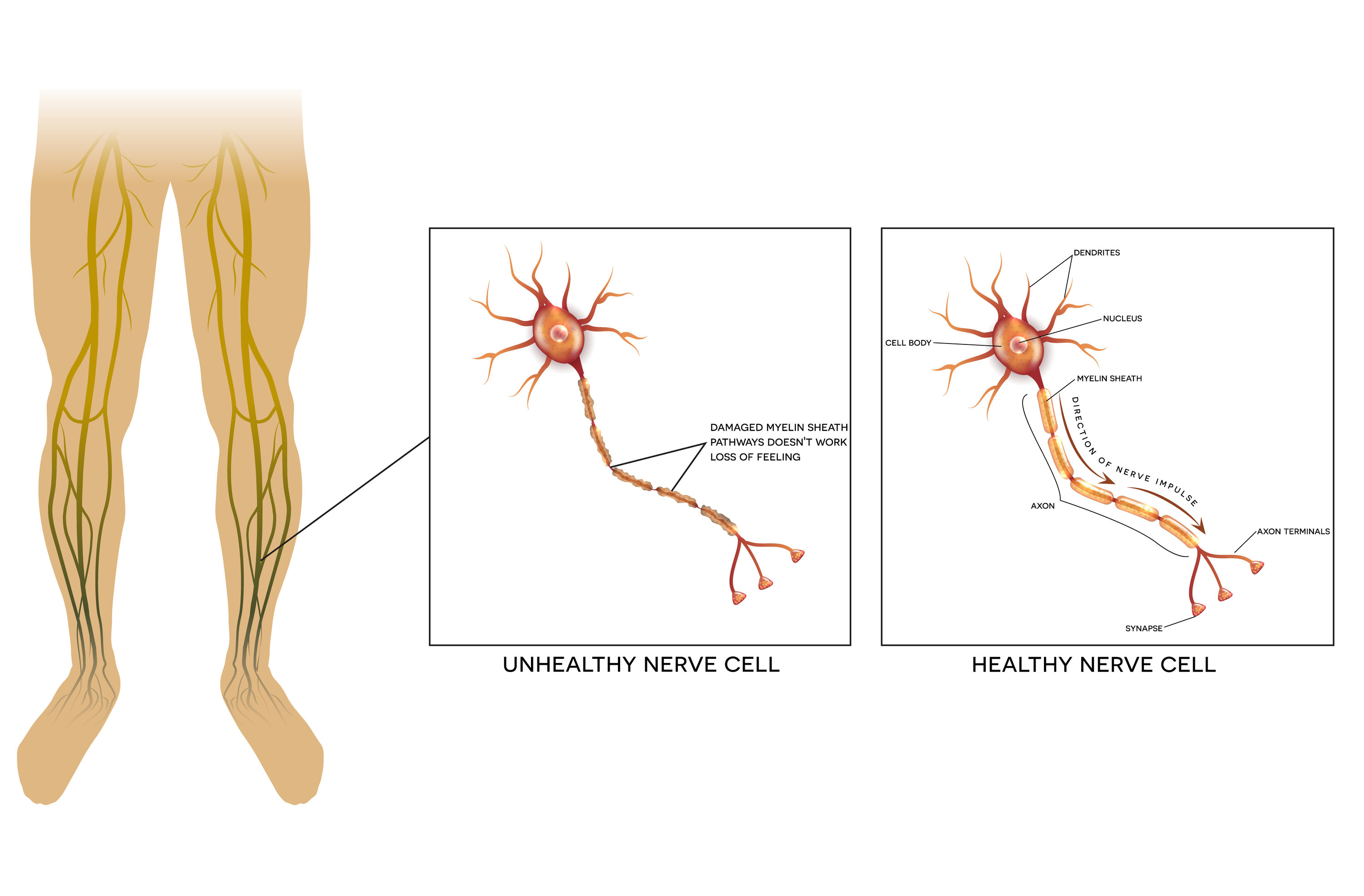 Peripheral Neuropathy Guide: Glutenfree Solutions