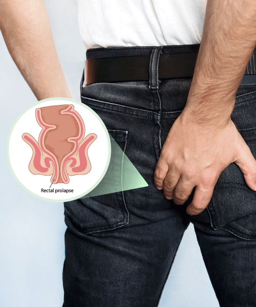 Photos Of Rectal Prolapse