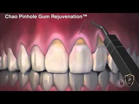 Pinhole Dental Procedure: Minimally Invasive Solution