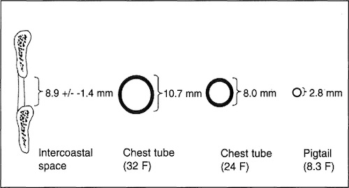 Pneumothorax Size For Chest Tube