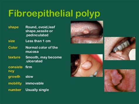 Polyp Inside Mouth