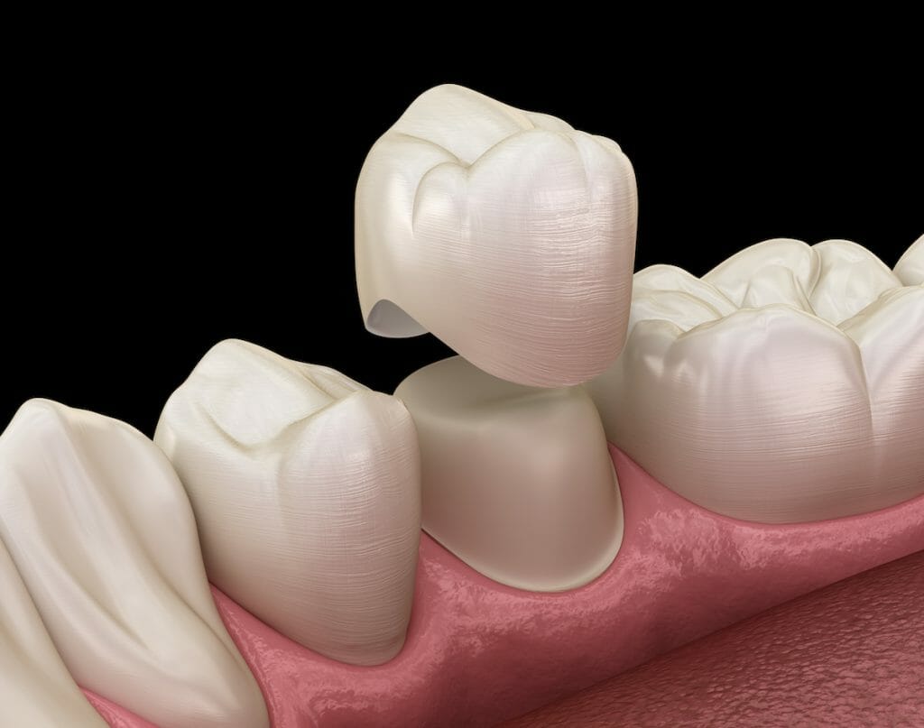 Porcelain Tooth Crown Cost