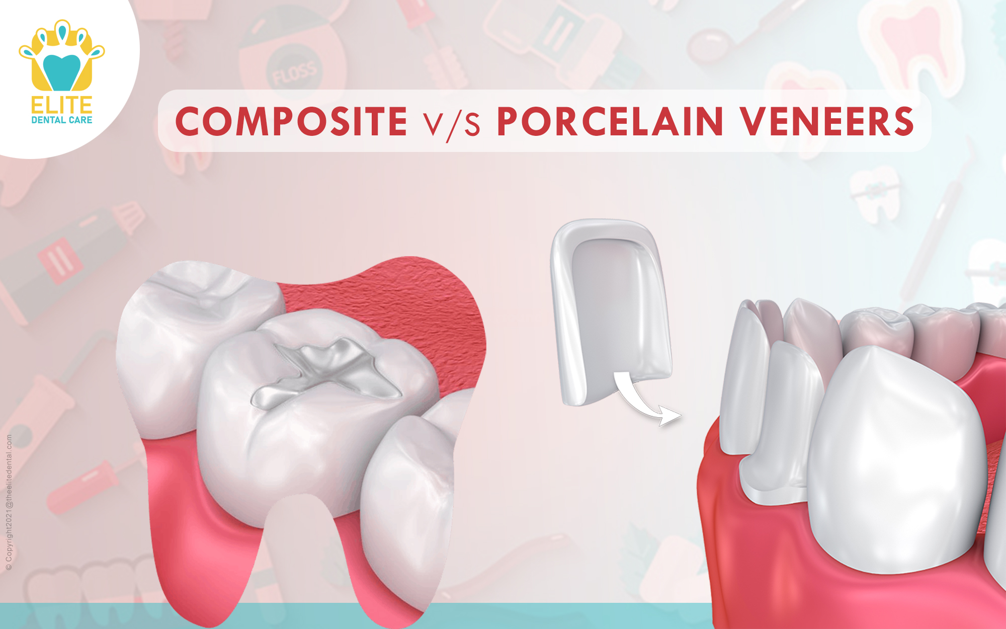Porcelain Vs Composite Veneers