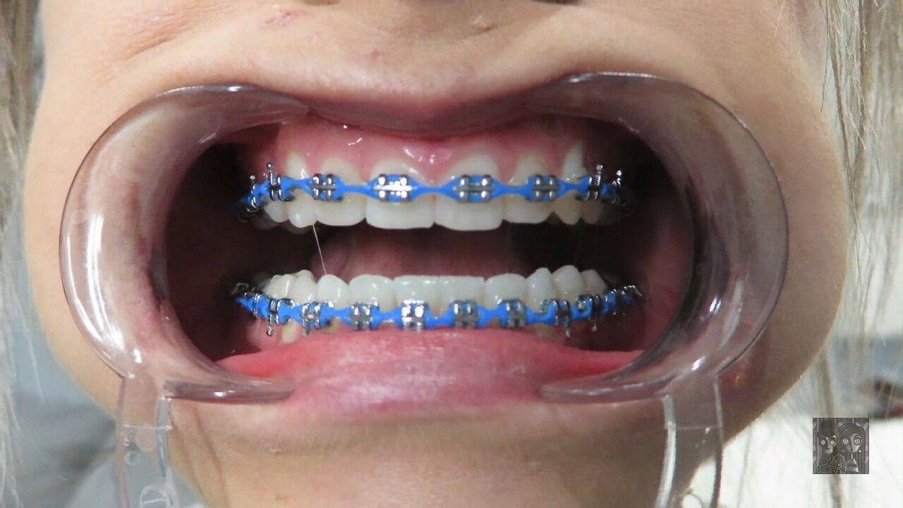 Power Chains Braces