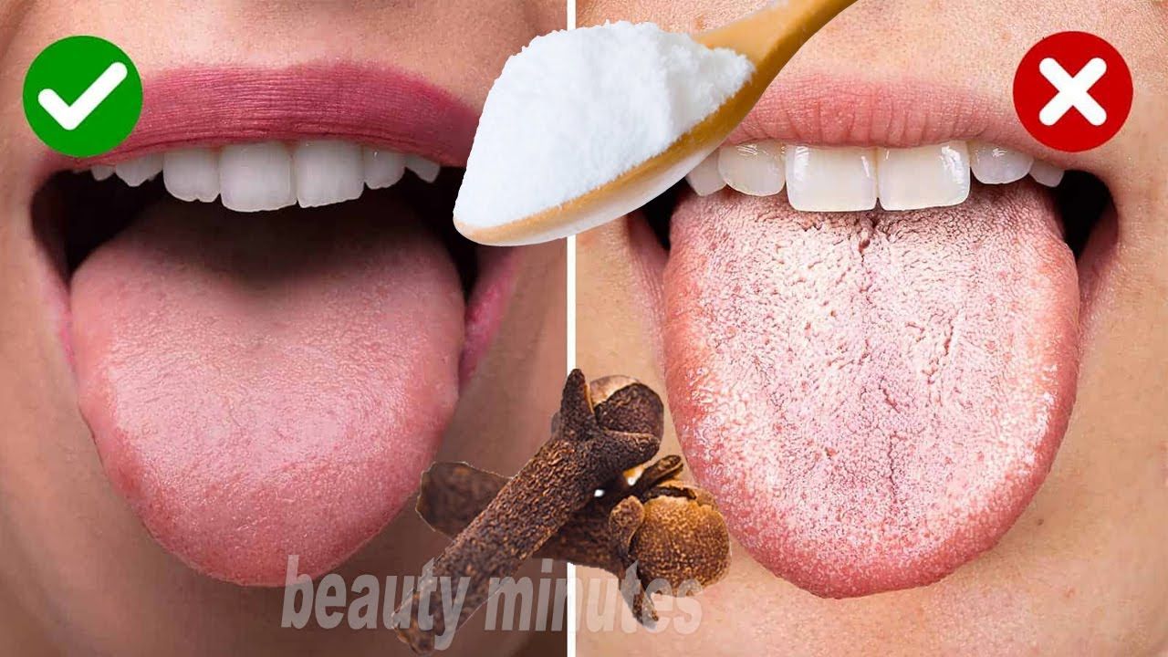 Pregnancy Tongue Ulcers Relief: Fast Healing