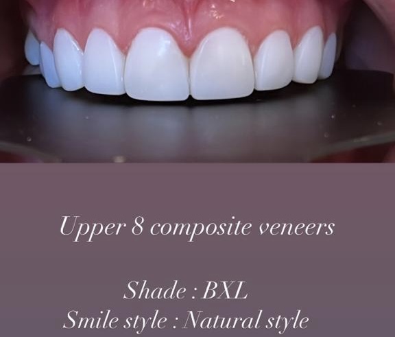 Price For Veneers Per Tooth Price For Veneers Per Tooth